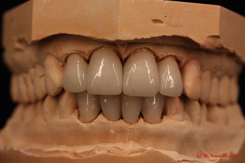 Maxillary and Mandibular Incisors