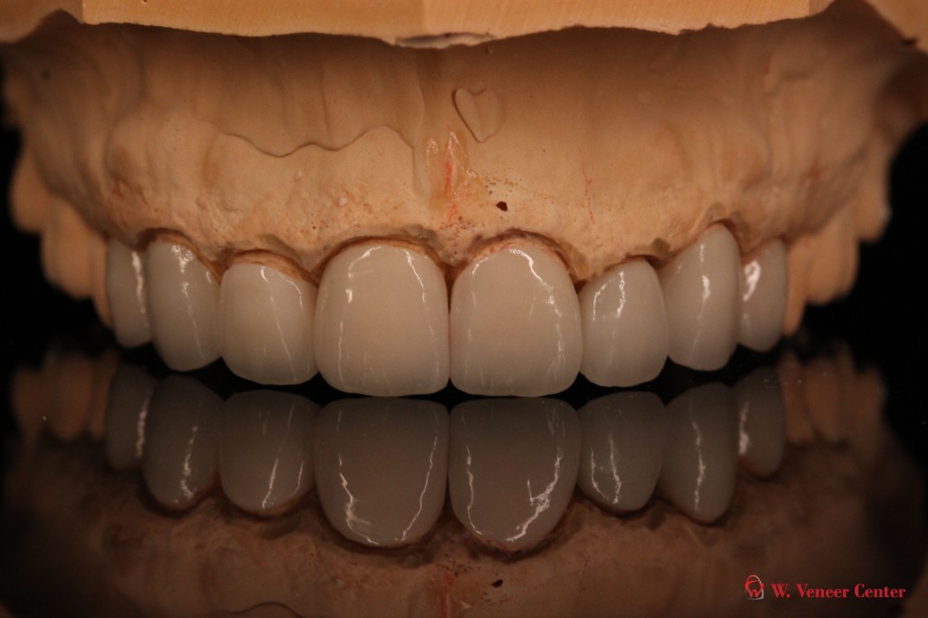 Maxillary Restorations