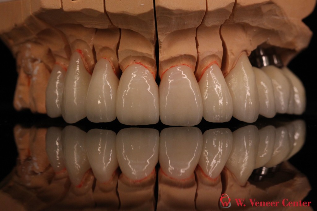 Maxillary E-max Restorations